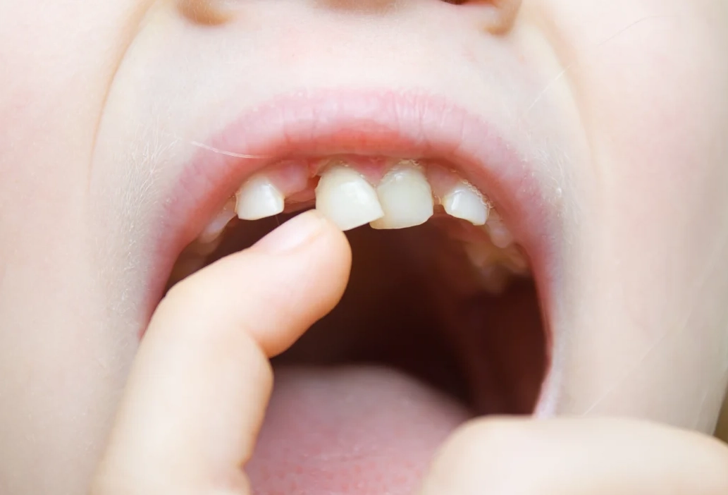 夢見牙齒鬆動脫落