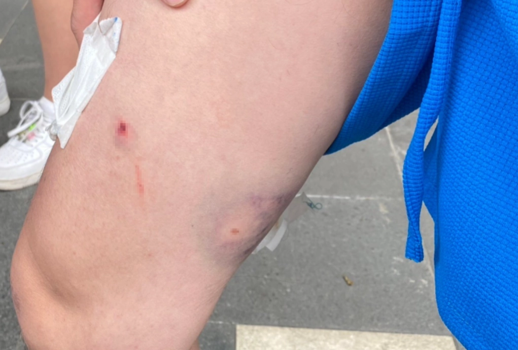 狗咬夢境心理學