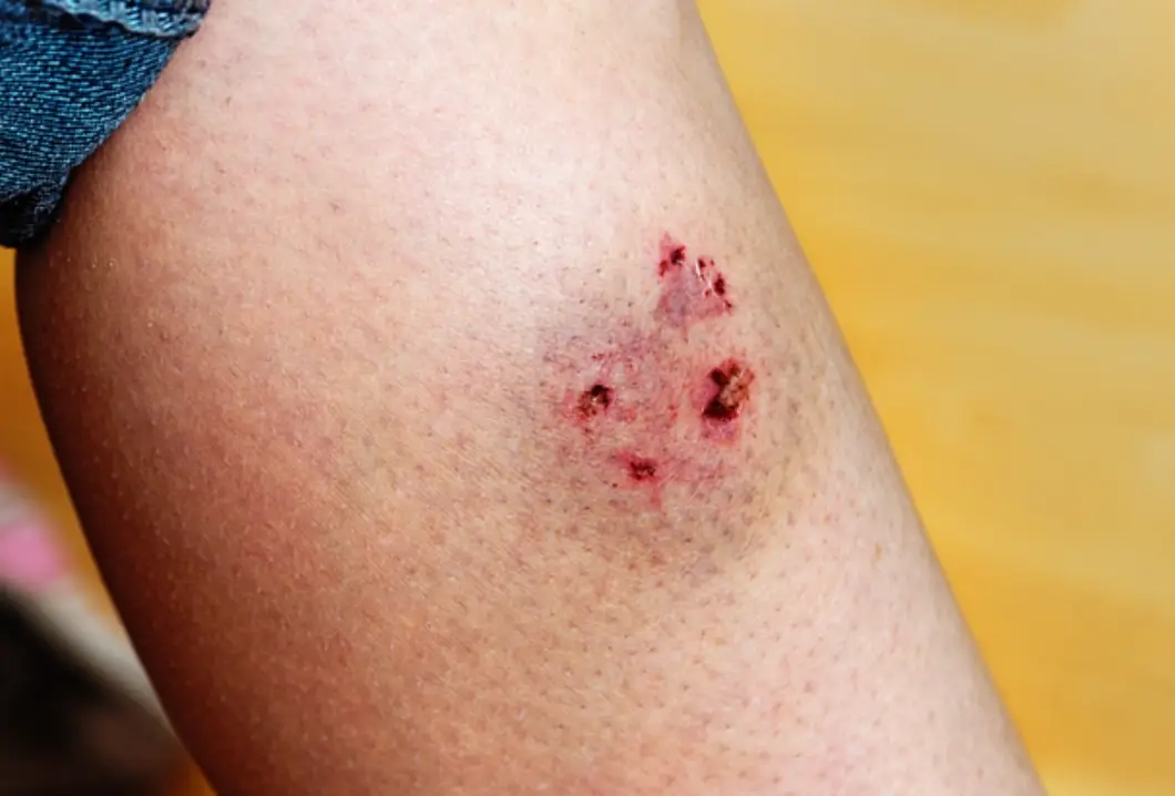 夢到被狗咬流血