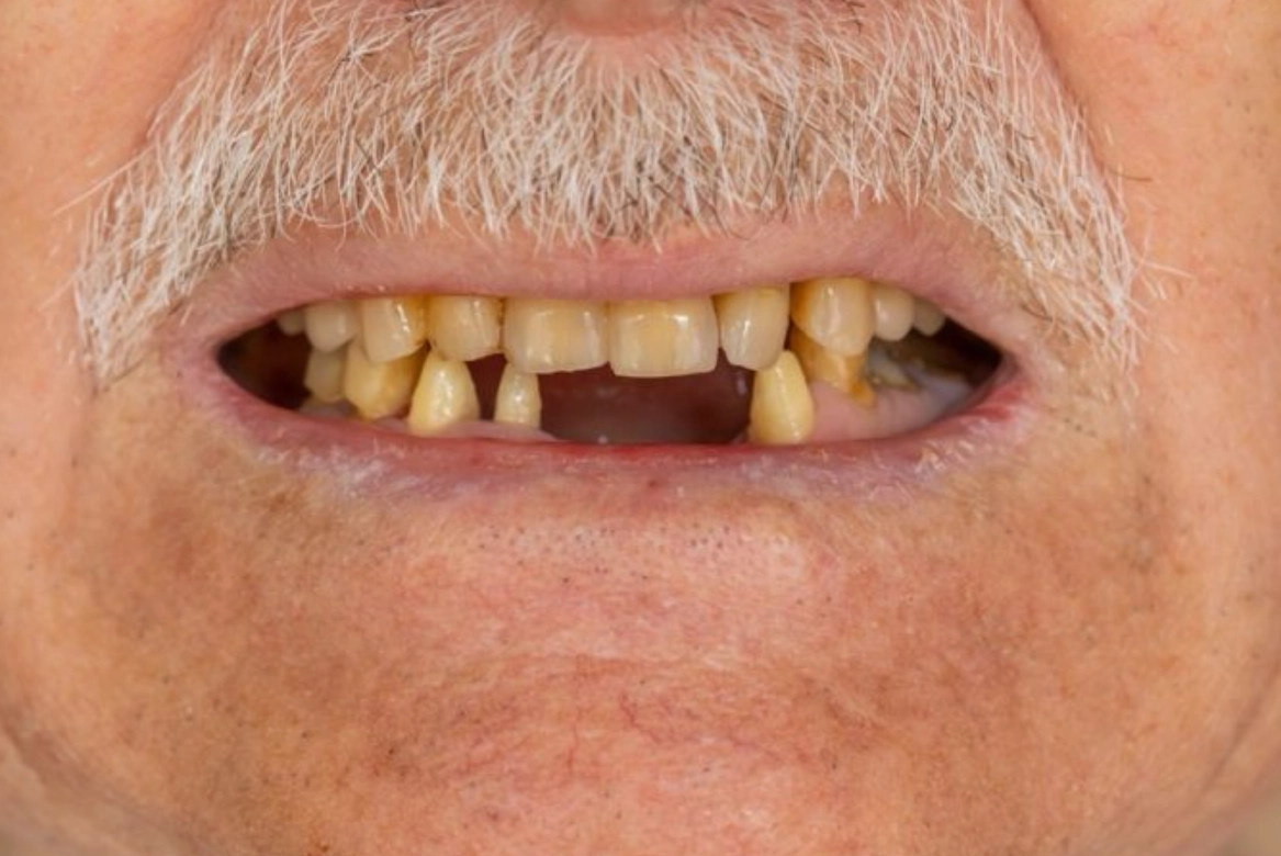 夢見牙齒掉兩顆