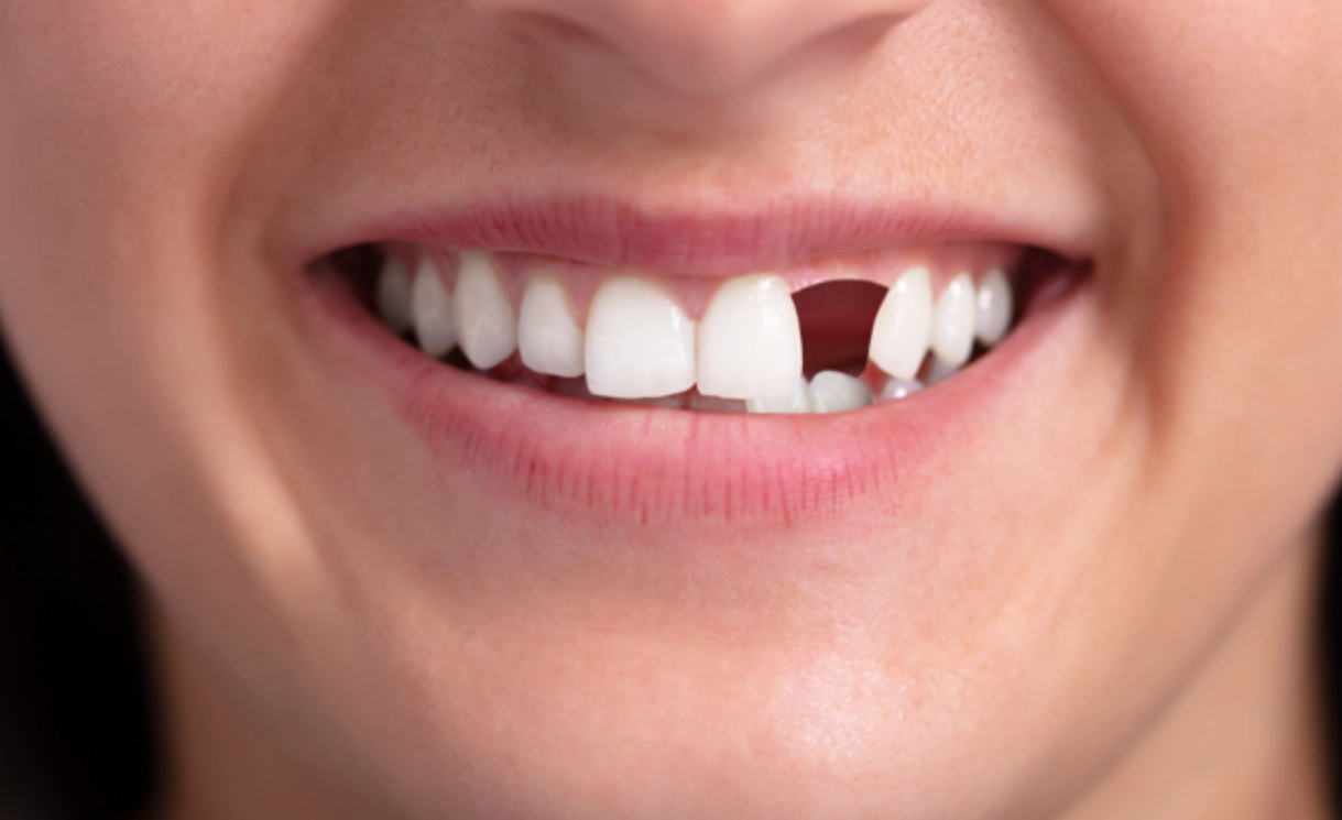 夢到牙齒掉一顆上牙 解夢