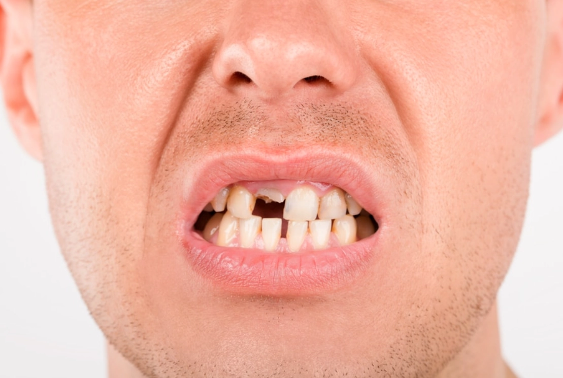 牙齒夢境 心理學