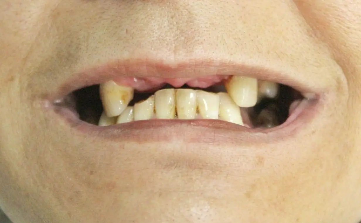 夢到牙齒掉落意思