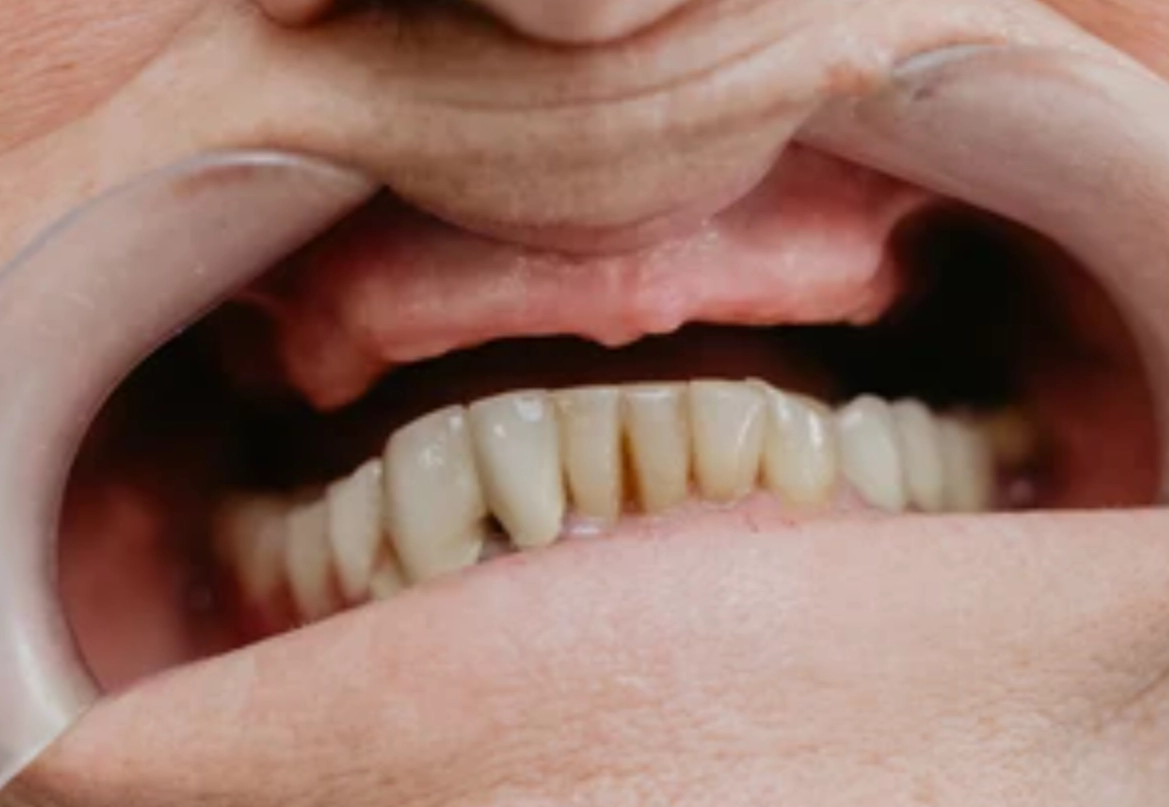 夢到牙齒掉一排