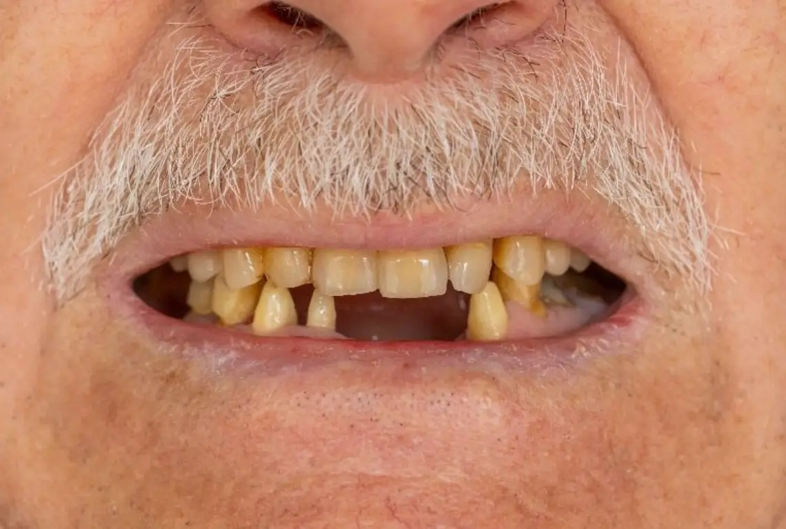 夢到掉兩顆牙齒