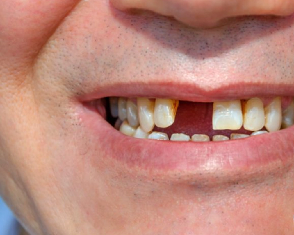 上牙掉落 夢境含義