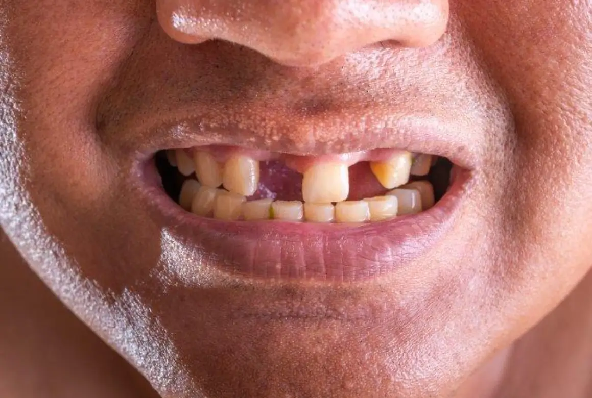 牙齒掉落夢境解析