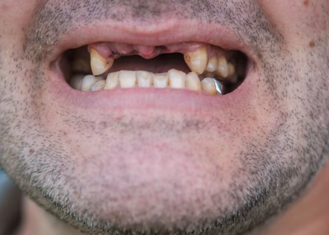 夢到牙齒掉落意思