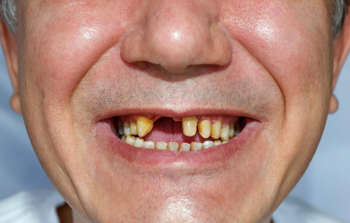 周公解夢掉牙齒