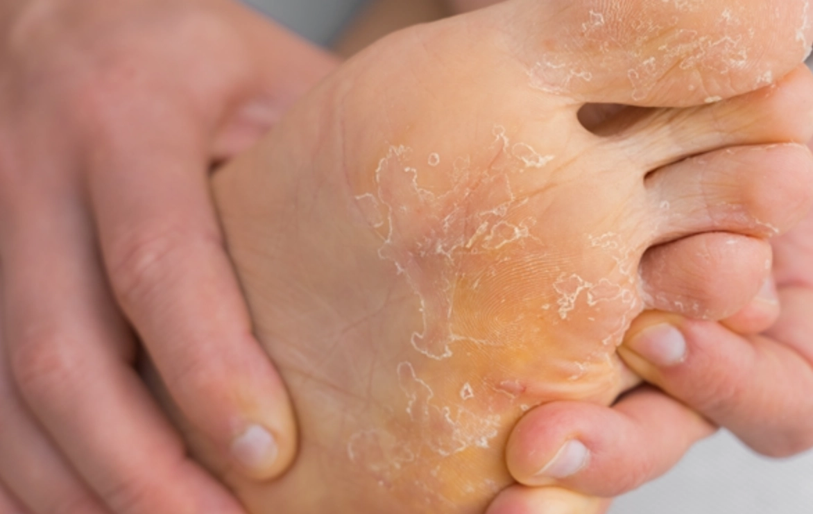 香港腳治療方法 香港腳治療方法