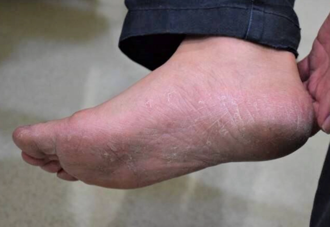 漂白水香港腳比例 漂白水香港腳比例