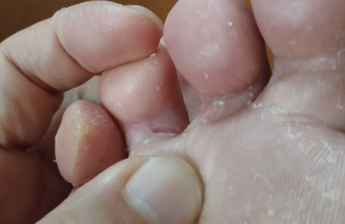 漂白水香港腳有效嗎 漂白水香港腳有效嗎