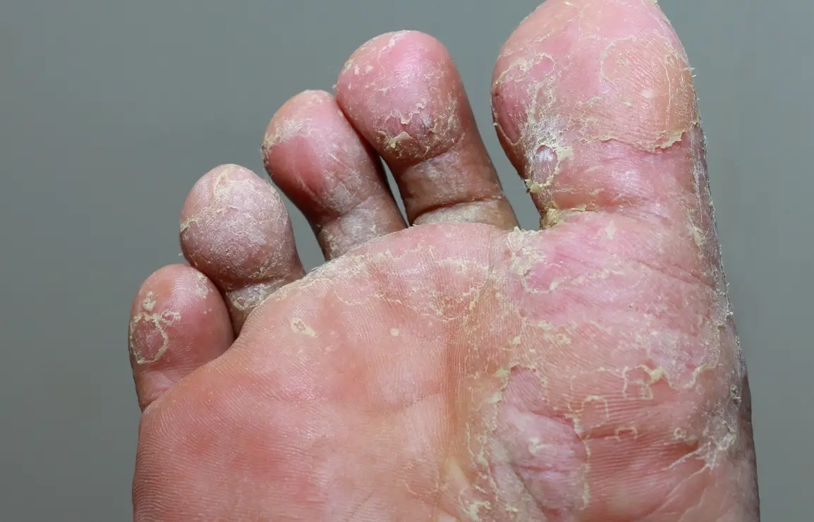 漂白水香港腳有效嗎 漂白水香港腳有效嗎