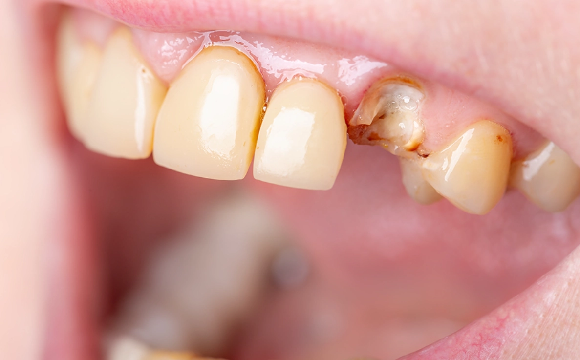 夢見牙齒斷一半意思