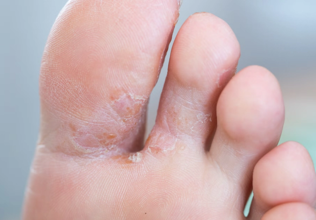 鞋子發霉香港腳