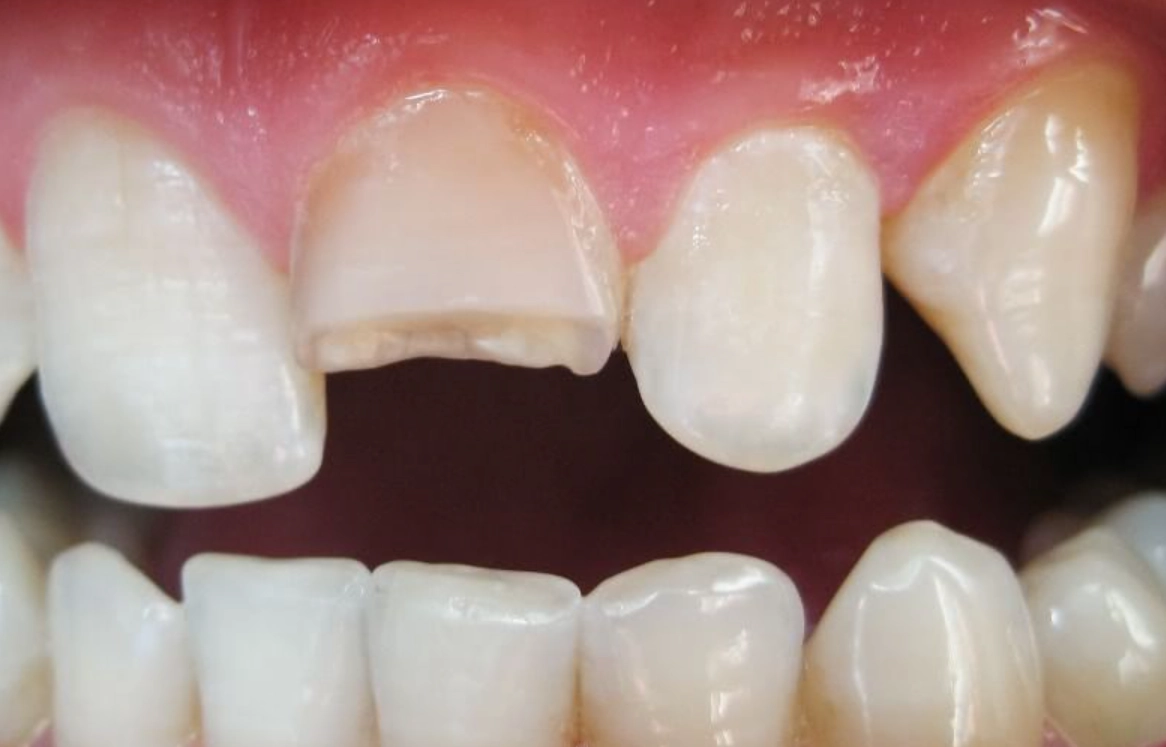 夢見牙齒斷掉解夢