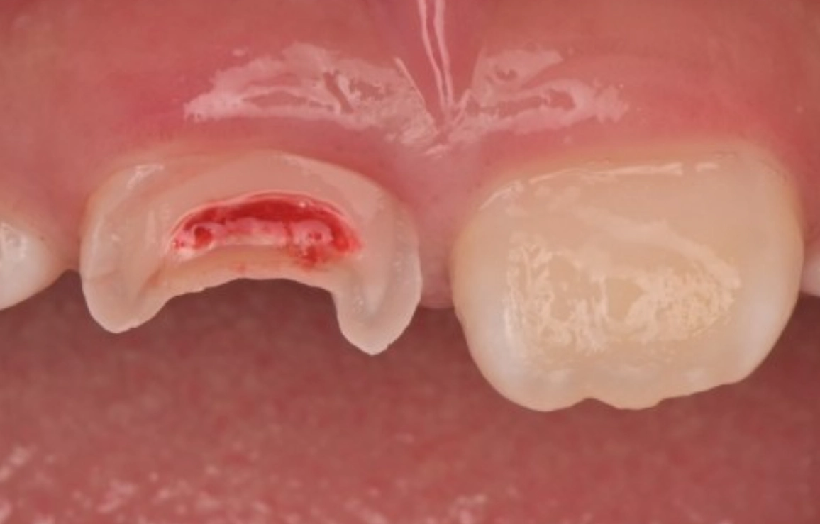 夢見牙齒斷一半