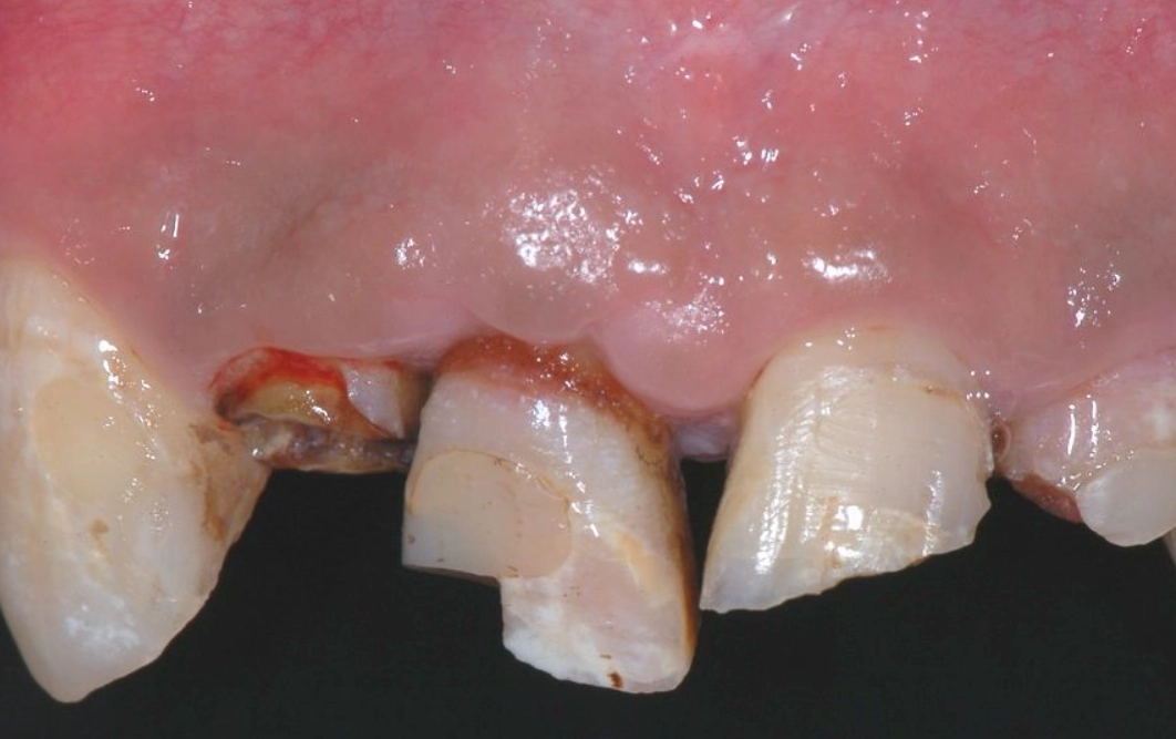 夢見牙齒斷掉解夢