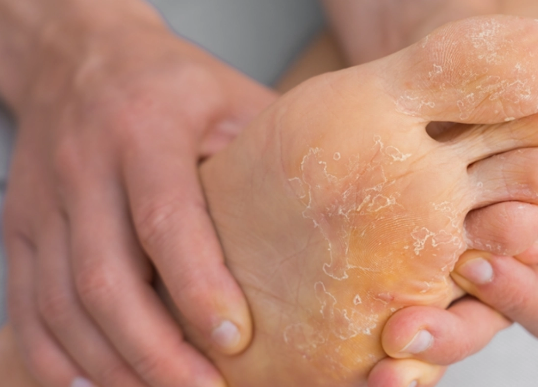 香港腳治療方法