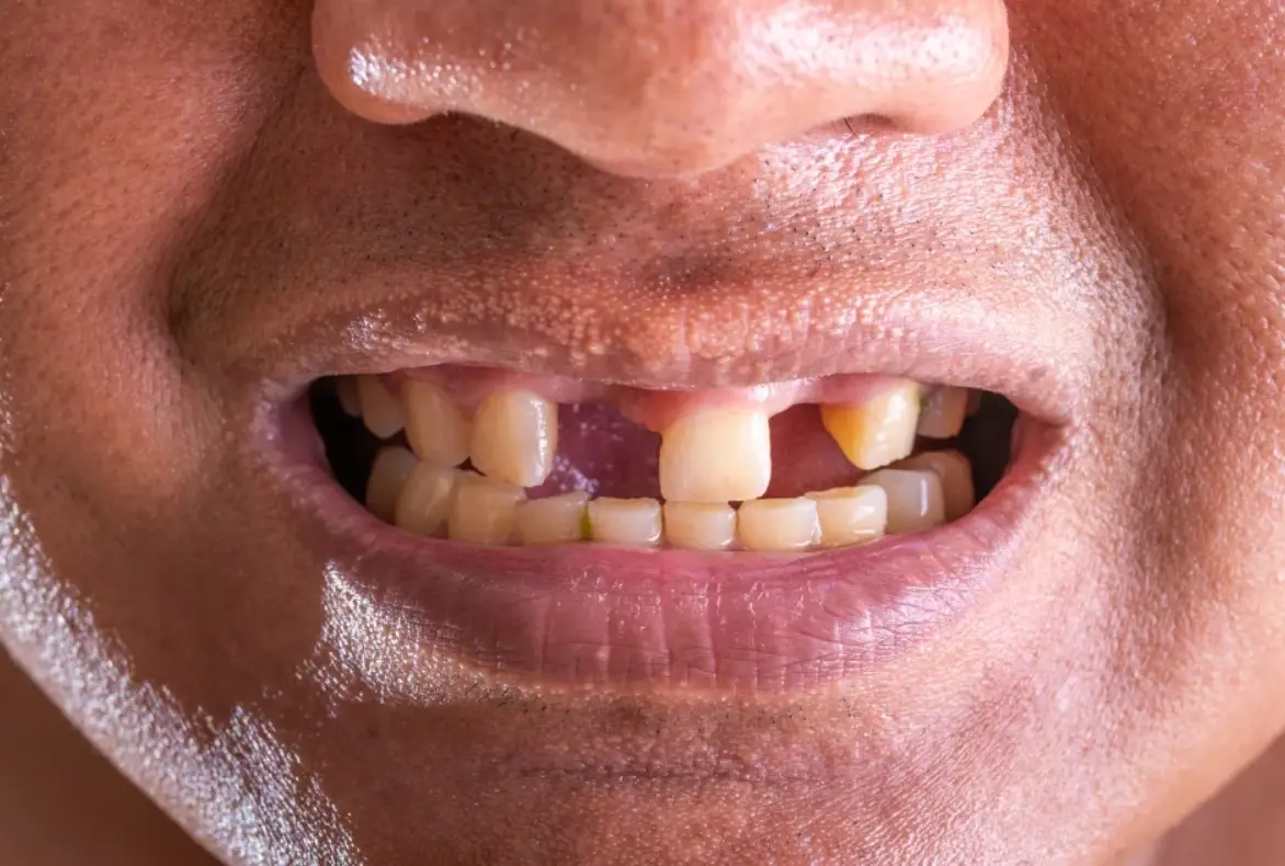 夢見牙齒掉了好幾顆