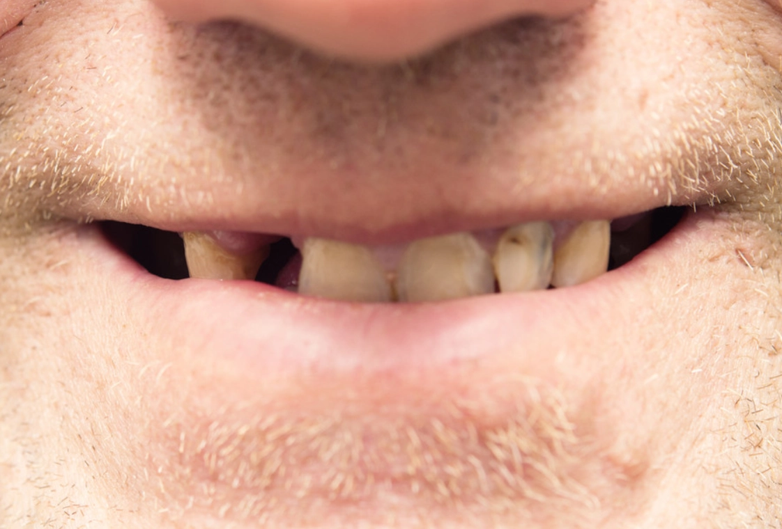 夢到牙齒掉很多