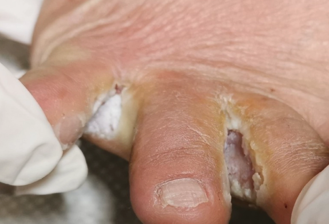 香港腳治療方法