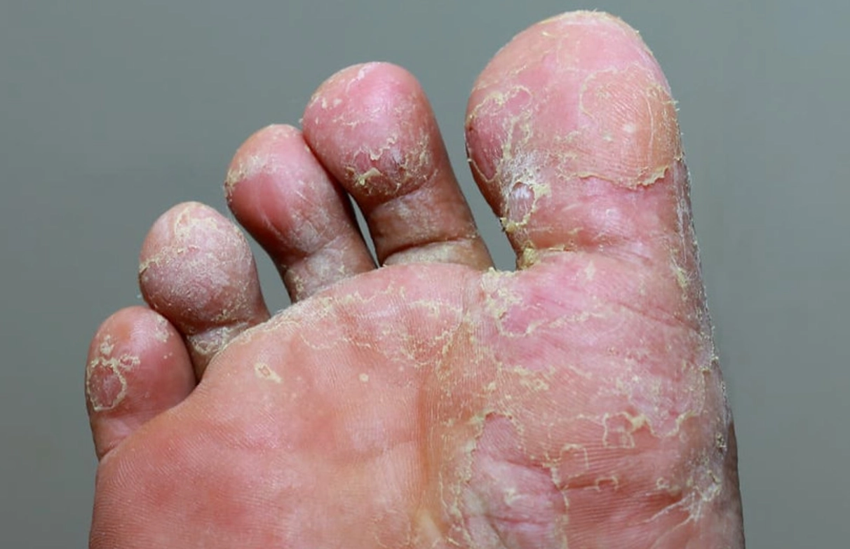 香港腳治療方法