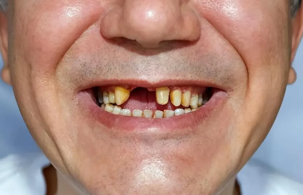 夢到牙齒掉落解夢