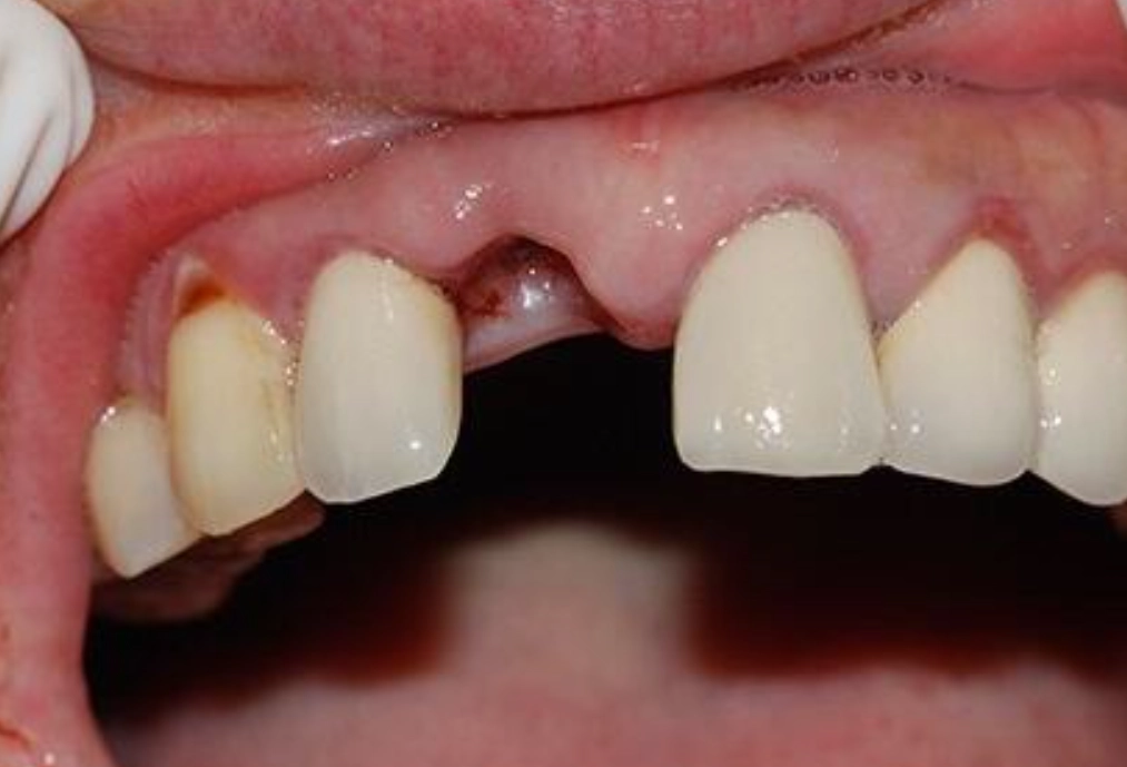 夢見牙齒掉一顆