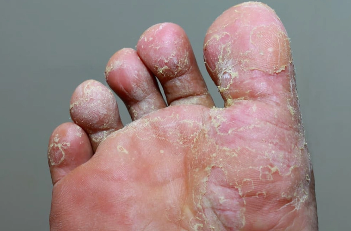 香港腳黴菌幾度會死