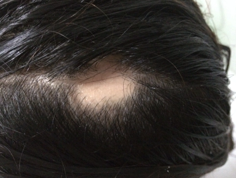 夢見頭頂禿一塊