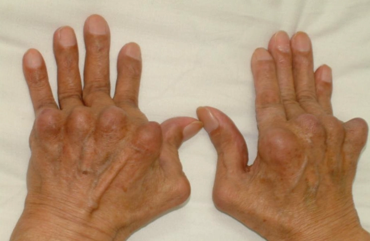 類風濕性關節炎病因