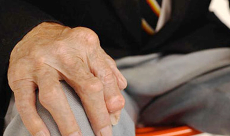 類風濕性關節炎病因