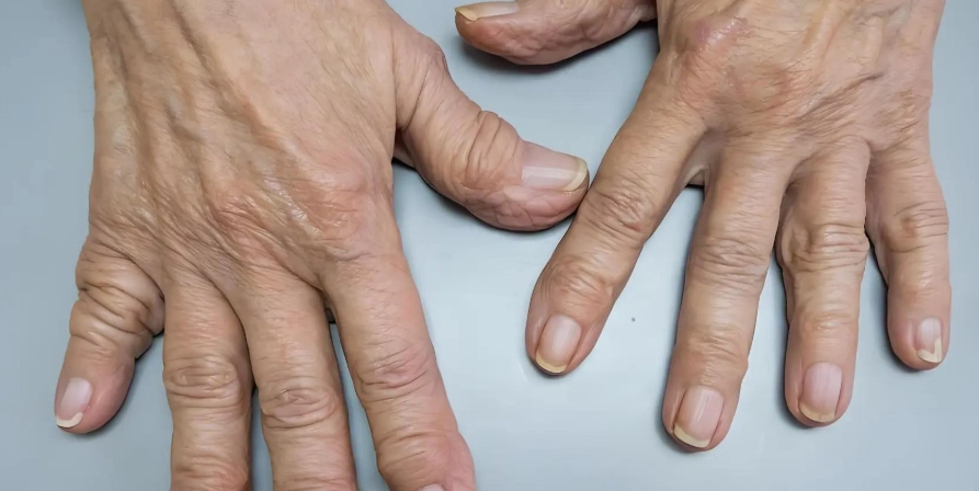 類風濕性關節炎原因