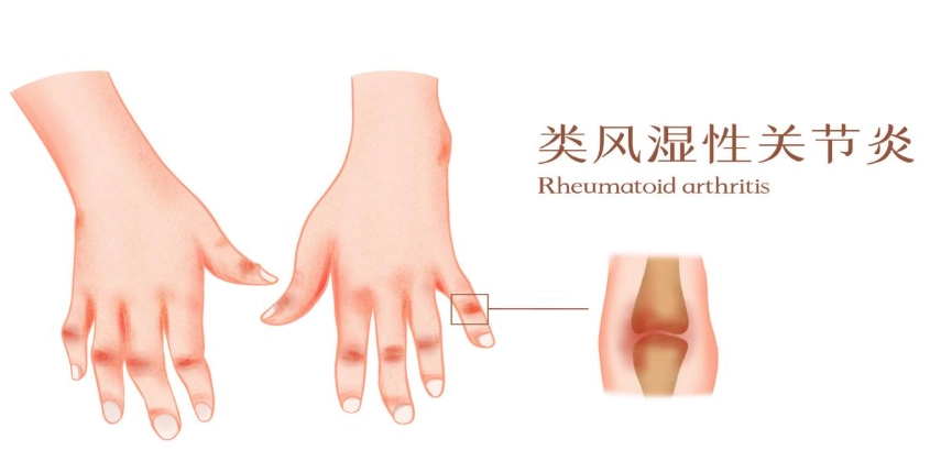 类风湿关节炎诊断 类风湿关节炎诊断