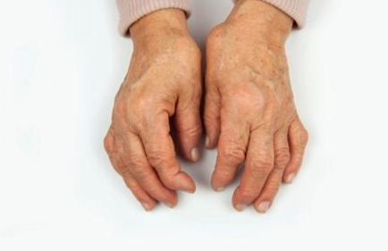 类风湿关节炎饮食建议 类风湿关节炎饮食建议