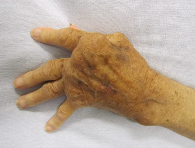 类风湿关节炎药物