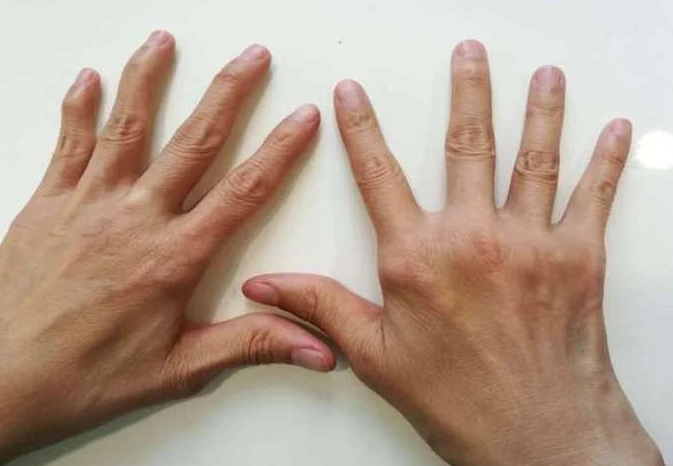 类风湿关节炎饮食指南