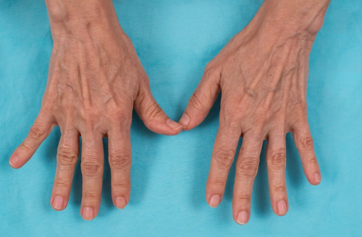 类风湿关节炎药物