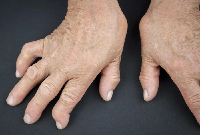 類風濕關節炎治療