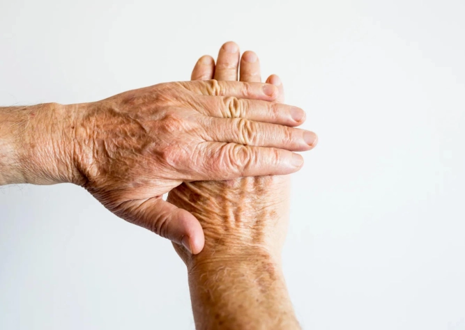 类风湿关节炎治疗