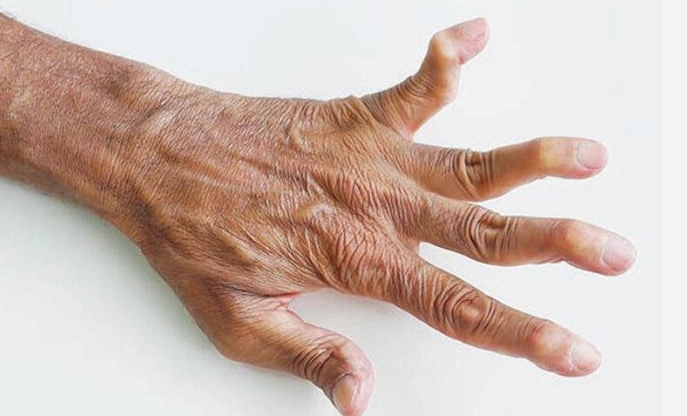 类风湿关节炎症状