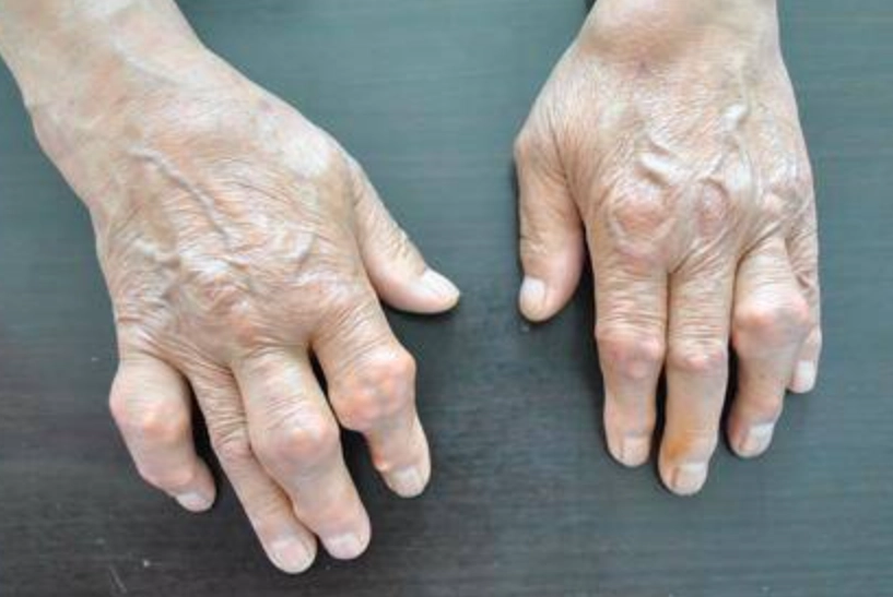 類風濕關節炎偏方