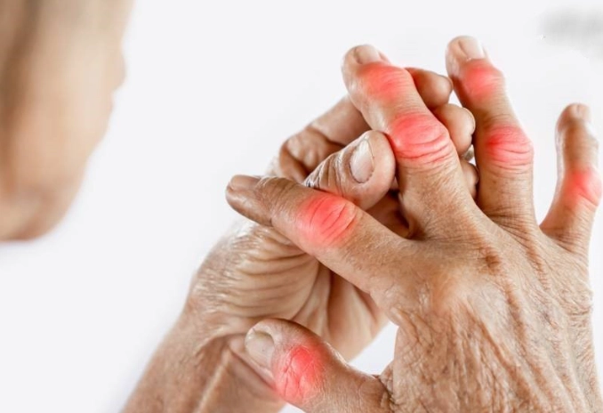 类风湿关节炎症状