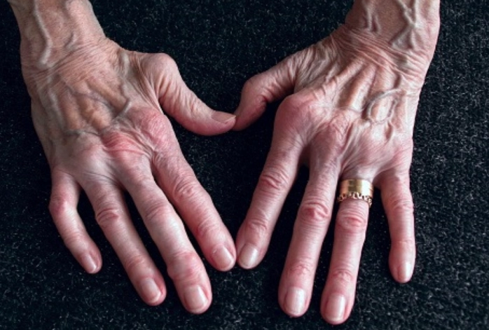 类风湿关节炎不能吃什么