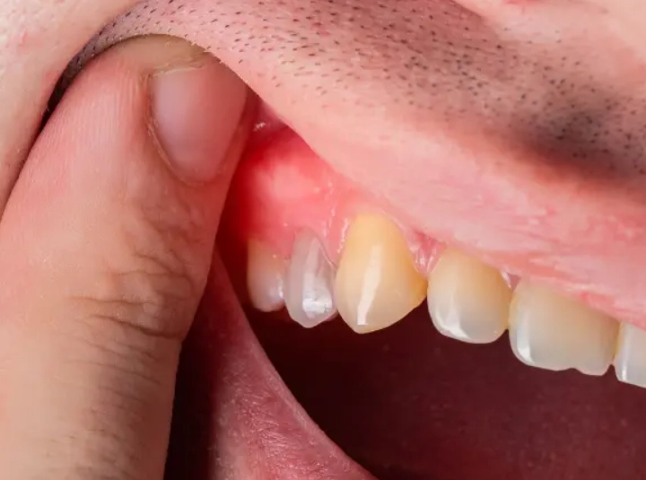 夢到牙齒鬆動解夢