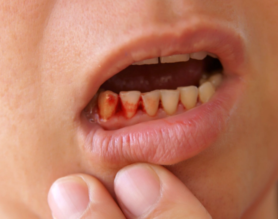 掉牙齒夢境解析