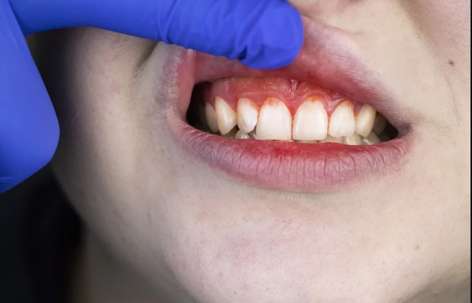 掉牙齒夢境解析