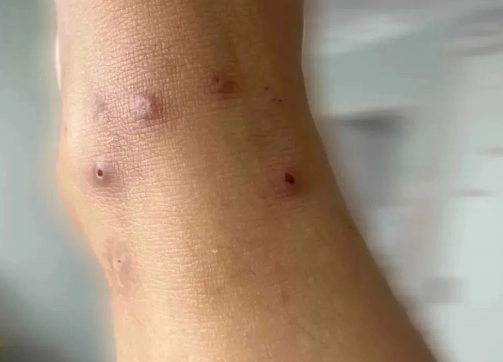 夢到被螞蟻咬 意思