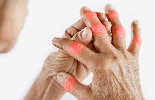 类风湿关节炎治疗偏方